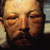 thumbnail image of Kaposi sarcoma: facial edema