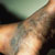 thumbnail image of Kaposi sarcoma: foot