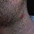 thumbnail image of Kaposi sarcoma: submandibular/cervical nodule