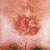 thumbnail image of Herpes simplex: perianal