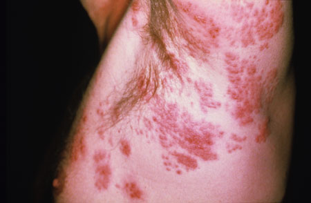 image of Herpes zoster