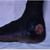 thumbnail image of Kaposi sarcoma: foot