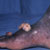 thumbnail image of Kaposi sarcoma: foot