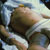 thumbnail image of Kaposi sarcoma: inner thigh, chest, arm