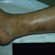 thumbnail image of Kaposi sarcoma: lesions after treatment