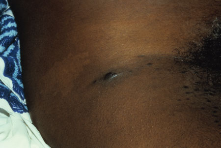 image of Kaposi sarcoma