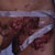 thumbnail image of Kaposi sarcoma