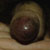 thumbnail image of Kaposi sarcoma: penis