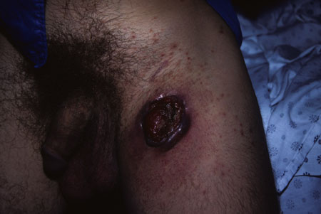 image of Kaposi sarcoma