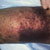 thumbnail image of Kaposi sarcoma