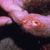 thumbnail image of Herpes simplex: genital