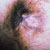 thumbnail image of Herpes simplex: perianal