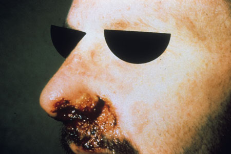 image of Herpes simplex