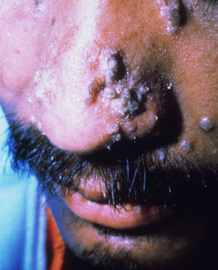 image of Varicella-zoster: acyclovir resistant