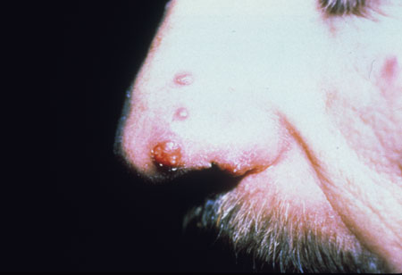 image of Tuberculosis