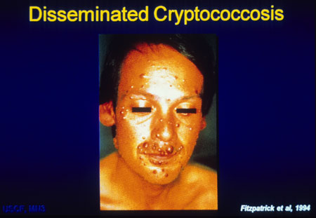 image of Cryptococcosis: disseminated
