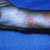 thumbnail image of Kaposi sarcoma: with staphylococcal abscesses