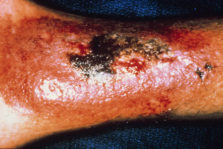 image of Kaposi sarcoma