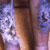 thumbnail image of Kaposi sarcoma: on bilateral shins