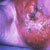 thumbnail image of Non-Hodgkin lymphoma