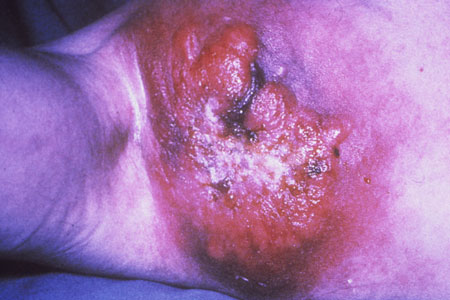 image of Non-Hodgkin lymphoma