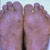 thumbnail image of Dermatophyte