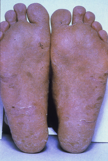 image of Dermatophyte