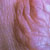 thumbnail image of Granuloma annulare