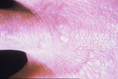 image of Granuloma annulare