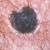 thumbnail image of Ecthyma