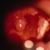 thumbnail image of Non-Hodgkin lymphoma: pharyngeal
