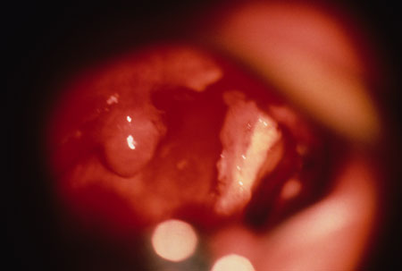image of Non-Hodgkin lymphoma: pharyngeal
