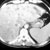 thumbnail image of Non-Hodgkin lymphoma: CT scan of liver