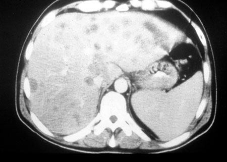 image of Non-Hodgkin lymphoma: CT scan of liver