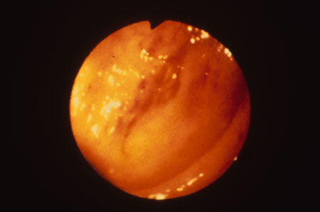 image of Kaposi sarcoma: lesion on intestinal mucosa