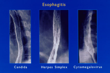 image of Esophagitis