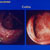 thumbnail image of Cytomegalovirus colitis