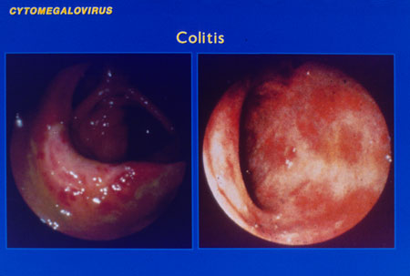 image of Cytomegalovirus colitis