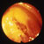 thumbnail image of Kaposi sarcoma: colon