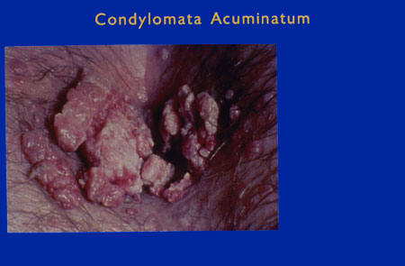 image of Condyloma acuminatum: anogenital warts (perianal)