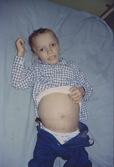 image of Non-Hodgkin lymphoma: abdominal manifestations in an HIV-infected boy
