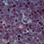 thumbnail image of Non-Hodgkin lymphoma: diffuse large-cell type