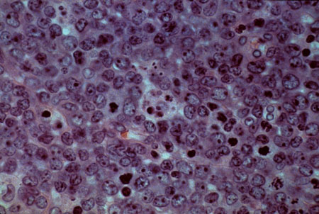 image of Non-Hodgkin lymphoma: diffuse large-cell type