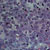 thumbnail image of Non-Hodgkin lymphoma: immunoblastic type
