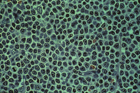 image of Non-Hodgkin lymphoma: small lymphocytic type