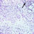 thumbnail image of Eosinophilic folliculitis
