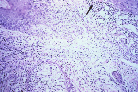 image of Eosinophilic folliculitis