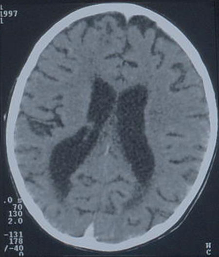 image of Brain atrophy: generalized, in an 8-year-old HIV-infected boy