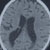 thumbnail image of Brain atrophy: generalized, in an 8-year-old HIV-infected boy