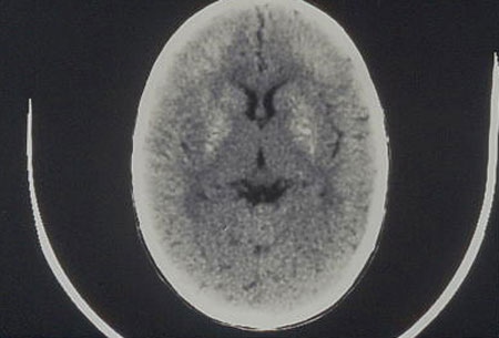 image of Basal ganglia calcifications: on head CT, suggestive of pediatric HIV infection